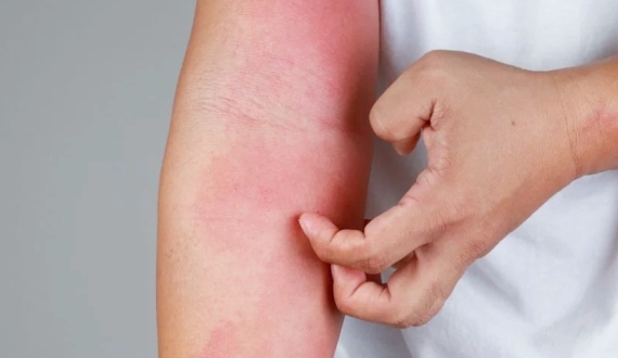 MCC_Website_Images_570x330_2_Allergic Contact Dermatitis