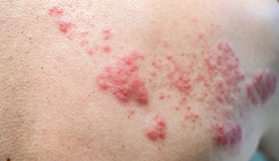 MCC_Website_Images_570x330_2_Painful Lesions