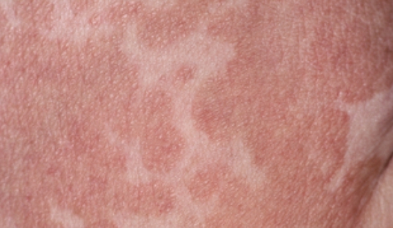 MCC_Website_Images_570x330_2_Pityriasis Versicolor