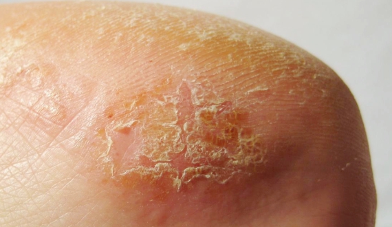 MCC_Website_Images_570x330_2_Scaling eczematous dermatitis